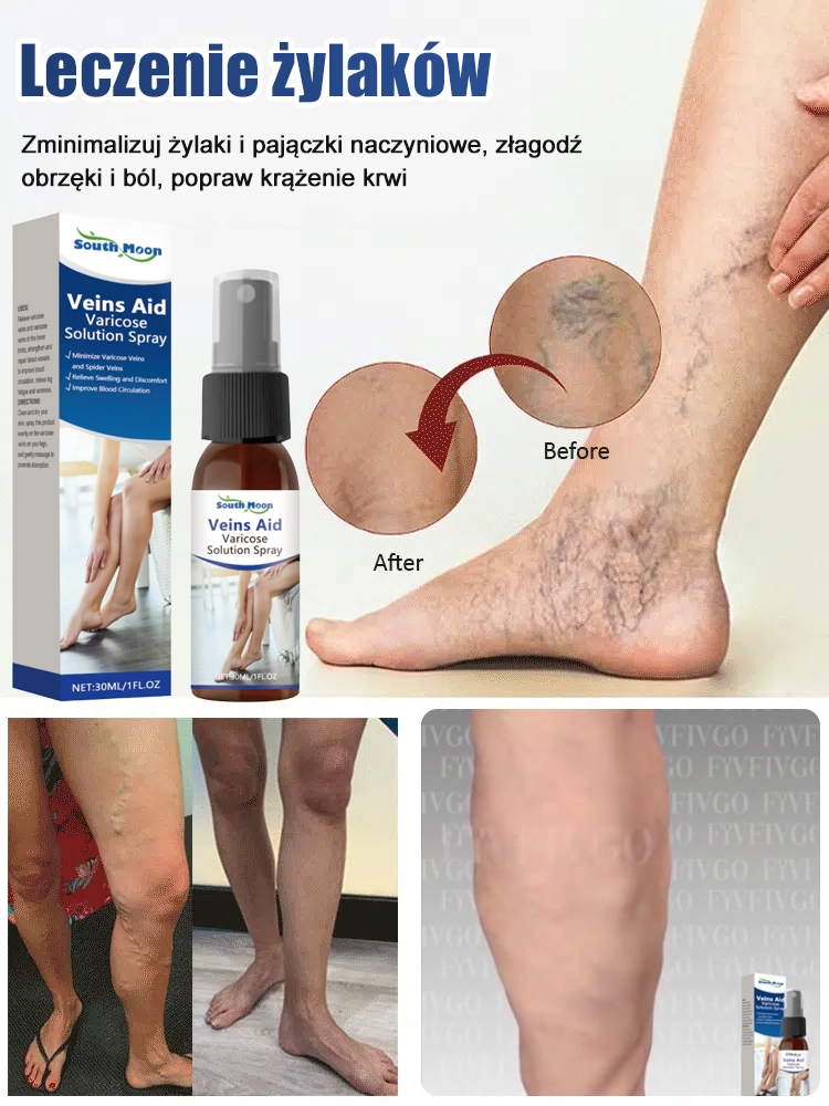 Spray do leczenia żył nóg